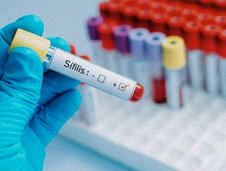 los-casos-de-sifilis-en-estados-unidos-son-los-mas-altos-desde-1950